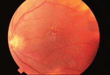 Photo of Age-Related Macular Degeneration (AMD): Symptoms, Causes, Treatment